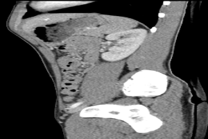 Eine MRT-Aufnahme eines Knies, die einen Riss in der Mitte zeigt, umgeben von einem dunklen Hintergrund.